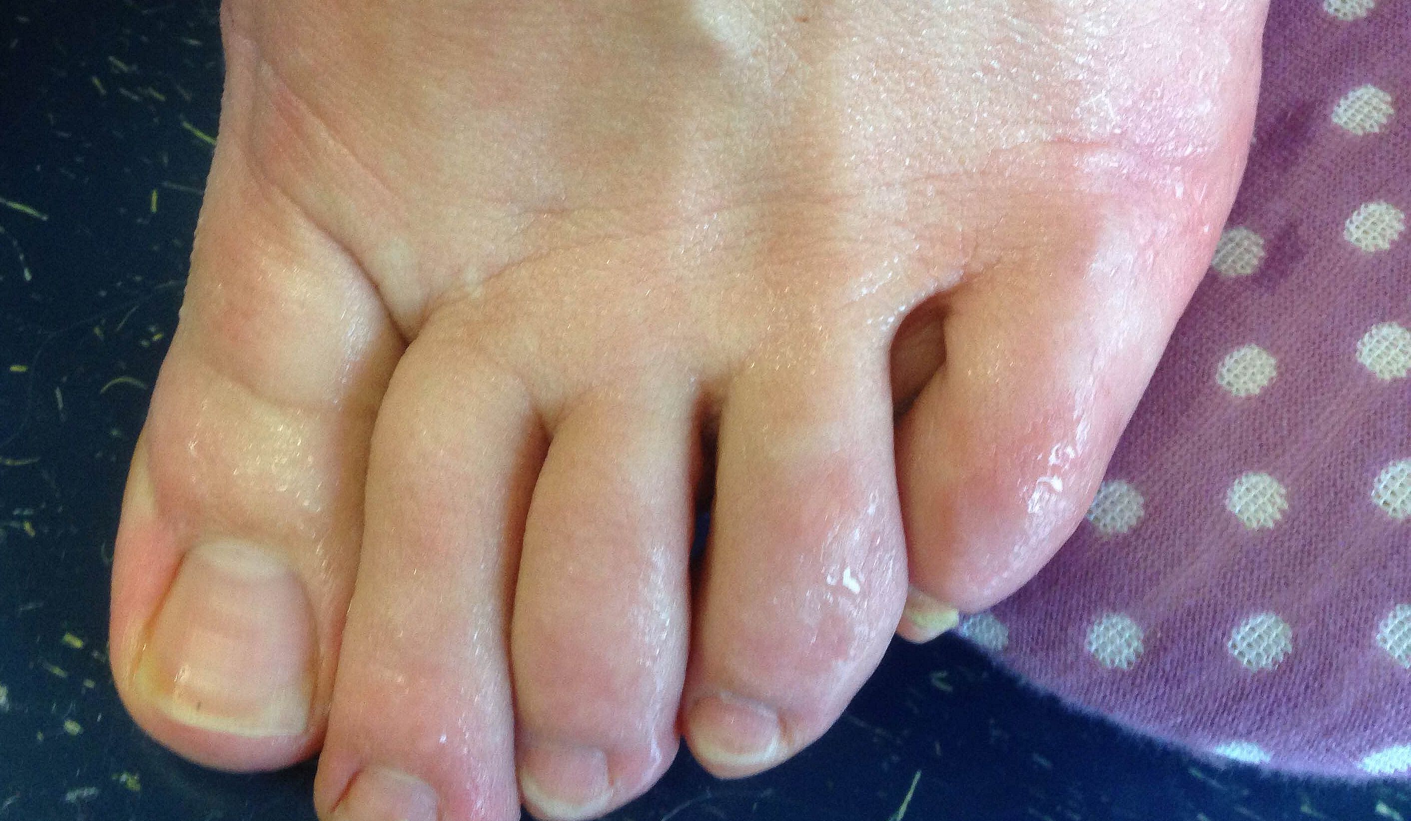 Plantar Hyperhidrosis Sweaty Feet